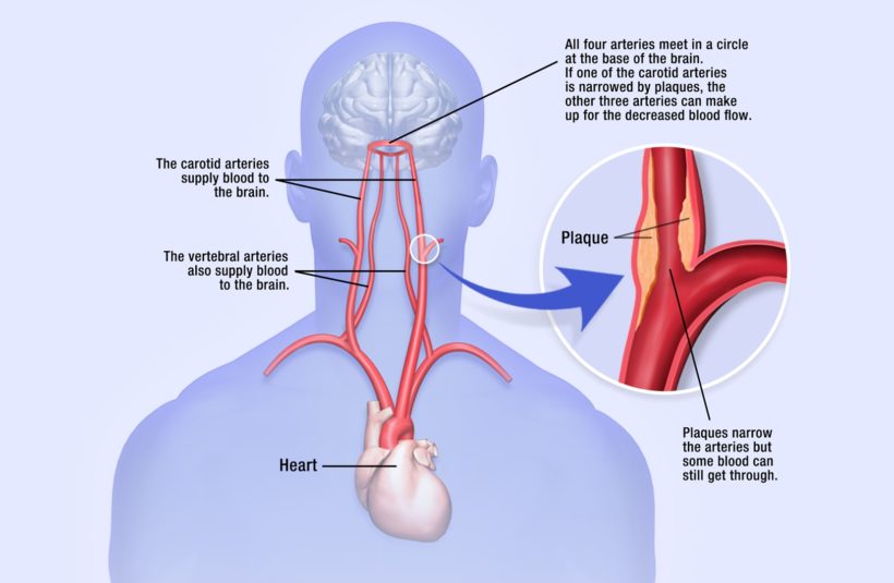 Carotid Artery Illustration - Pridgeon Design Group