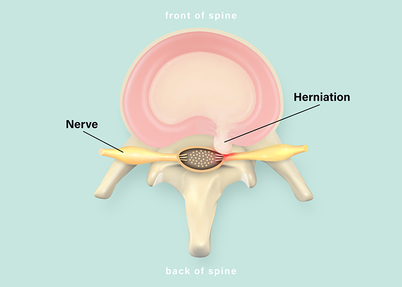 Herniated Disc Illustration For Health Dialog | Pridgeon Design Group